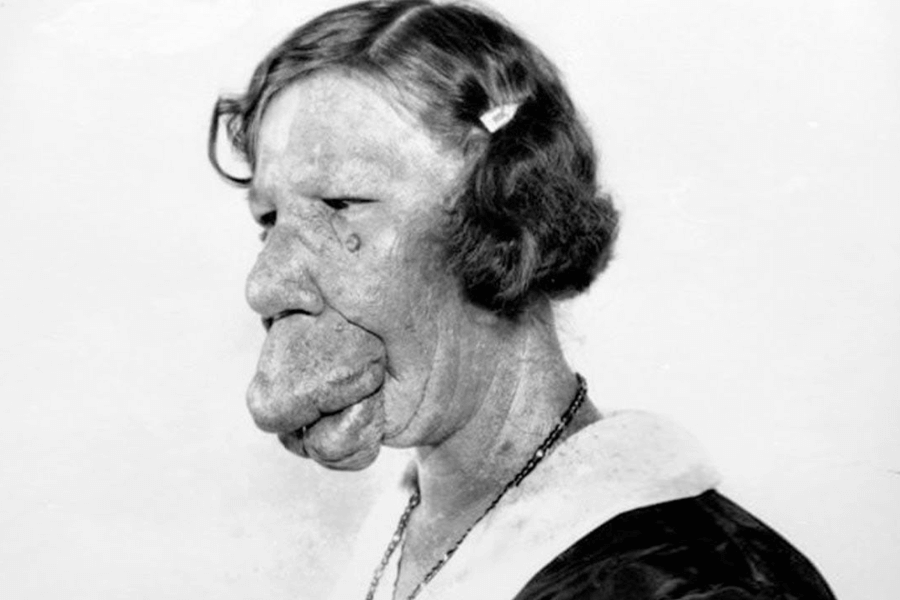 Black and white portrait of a woman with a severe facial deformity, likely due to a medical condition such as neurofibromatosis or another genetic disorder, highlighting the historical stigma and lack of medical support for individuals with visible differences.