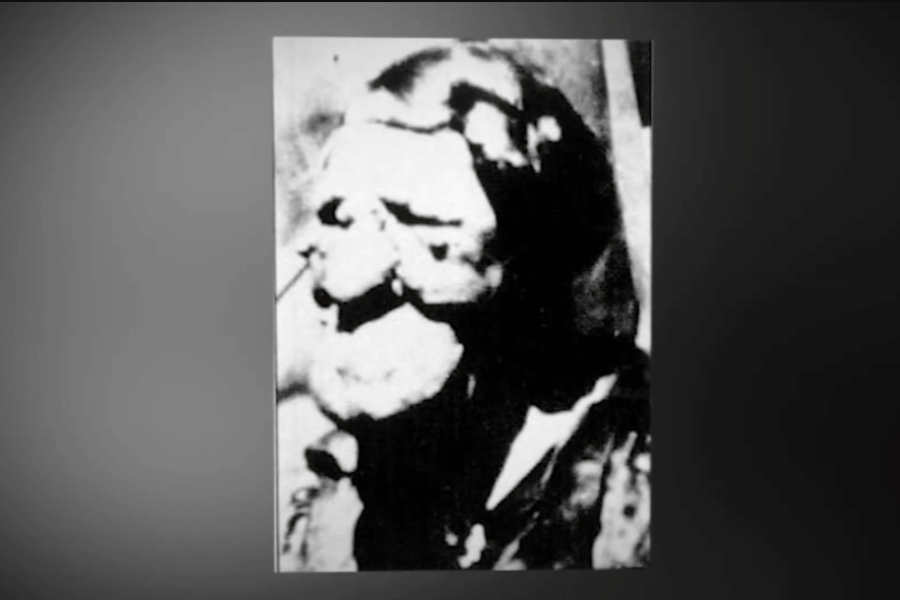 Grainy black and white photo of an individual with extreme facial disfigurement, possibly due to a congenital condition such as neurofibromatosis or a tumor disorder. The image quality is poor, but the person’s facial features appear heavily distorted, representing both the medical challenges and historical stigma faced by those with visible differences.