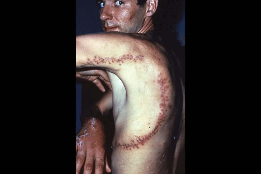 A man turns to show a large, curved scar across his side and back, the wound clearly healed with prominent stitches and scar tissue. His skin also shows abrasions and healing wounds on his arm, likely from a severe animal attack.