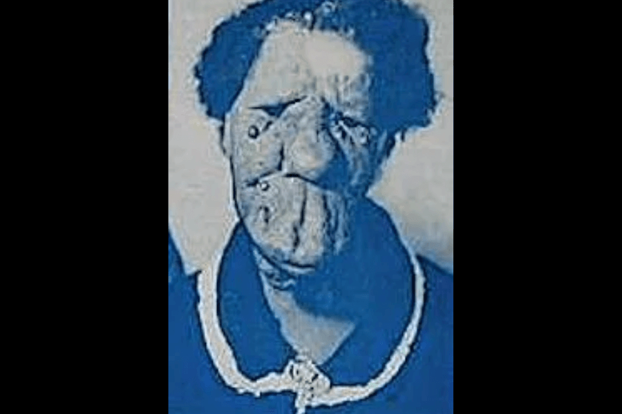High-contrast, blue-tinted portrait of Grace McDaniels, a woman with Sturge-Weber syndrome whose face is visibly affected by the condition. She wears a dark blouse with a white-trimmed collar and faces the camera with a composed expression. The artistic coloring emphasizes her facial features and evokes a somber, archival tone, reflecting both her historical significance and the ongoing need to humanize those once objectified.