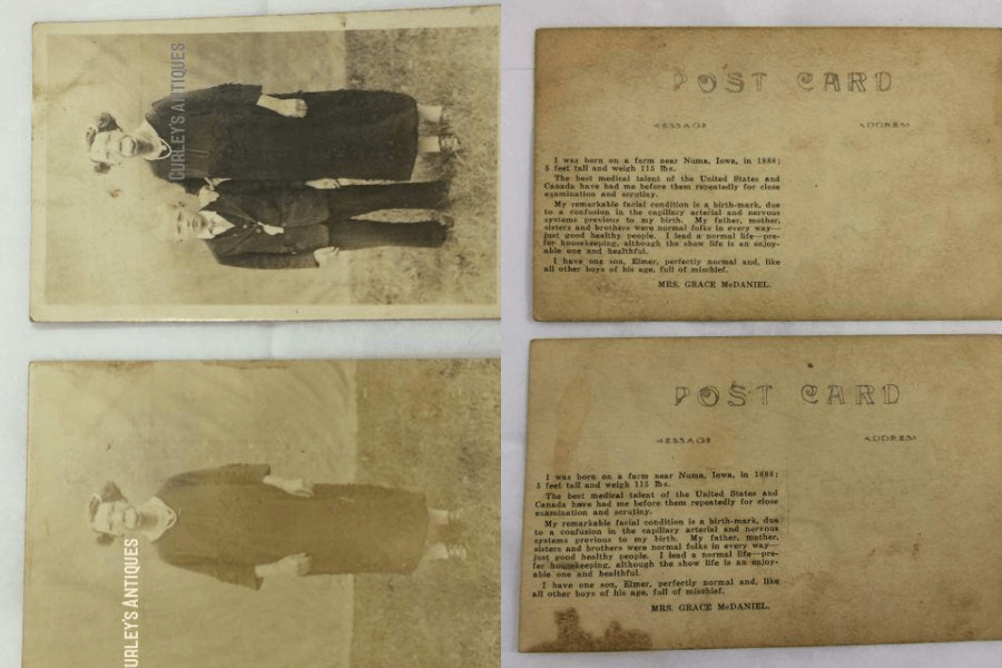 Composite image showing the front and back of two vintage postcards featuring Grace McDaniels, a woman with severe facial disfigurement caused by Sturge-Weber syndrome. The top postcard depicts her standing next to her young son Elmer, both dressed formally; the bottom shows Grace alone in the same setting. The backs of both postcards include a personal printed message from Grace, explaining her condition as a birthmark caused by a capillary and nervous system disorder, affirming her normal family life and expressing pride in her son. The postcards are watermarked “Curley’s Antiques.”