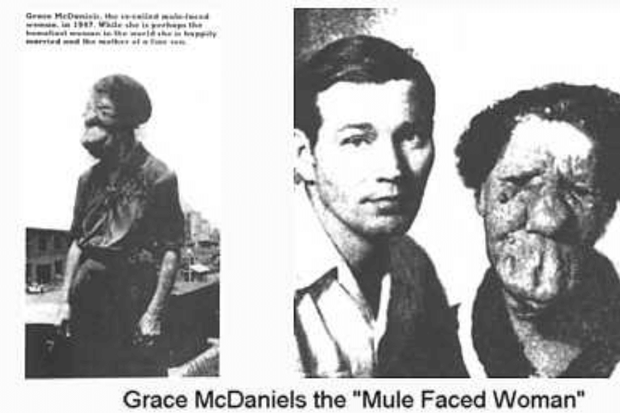 Composite black and white image featuring two photographs of Grace McDaniels, a woman with a severe facial deformity from Sturge-Weber syndrome. On the left, she stands alone outdoors, wearing a dark blouse and skirt. On the right, she is shown in a portrait with her son Elmer, both looking at the camera. Despite the text calling her the “Mule-Faced Woman,” the images reflect her lived experience as a mother and human being, beyond the sideshow label.