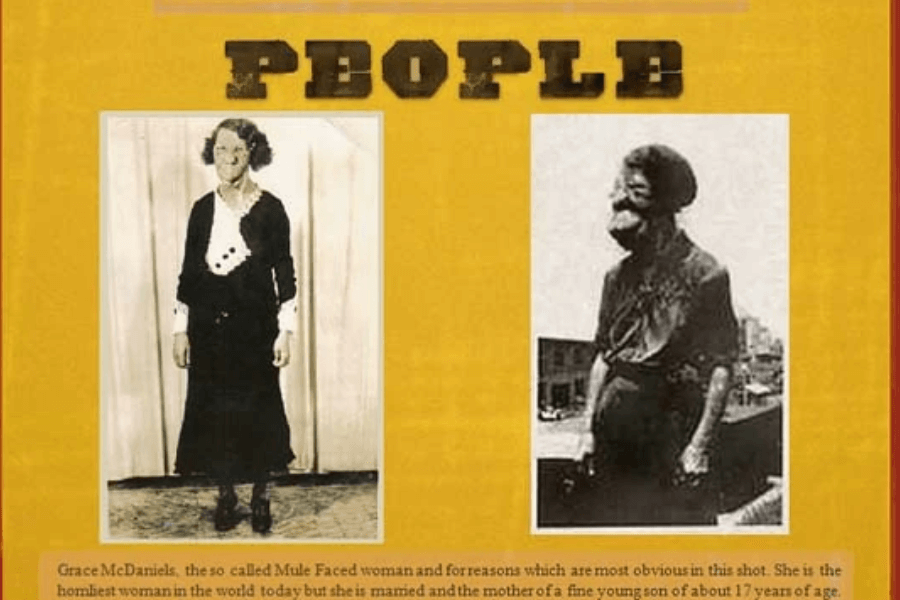 Yellow-toned poster-style layout with the word “PEOPLE” in bold black letters at the top. It features two photographs of Grace McDaniels, one posed indoors in a formal dress and one outdoors in profile, where her facial disfigurement due to Sturge-Weber syndrome is visible. The text beneath uses outdated, sensational language to describe her as “the homliest woman in the world,” but notes that she was married and had a son. The layout reflects how individuals with visible differences were once publicly labeled and displayed under exploitative narratives.