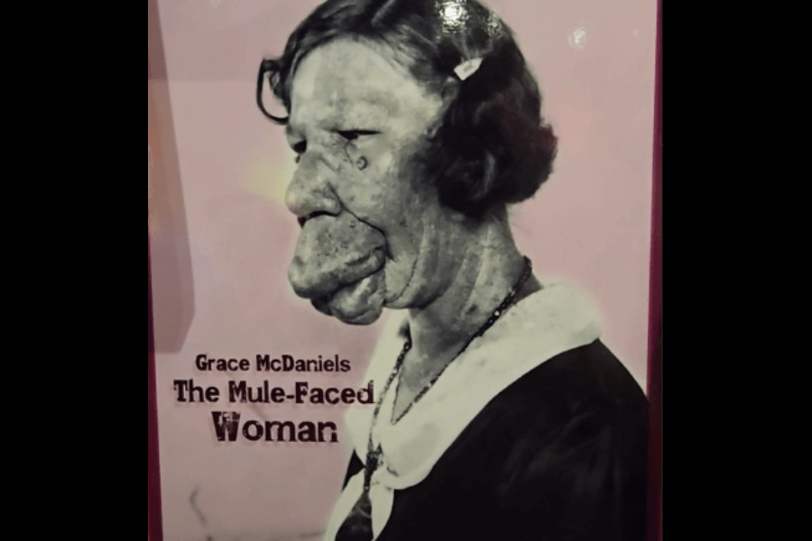 Poster-style image featuring a black-and-white portrait of Grace McDaniels in profile, showing her severe facial disfigurement caused by Sturge-Weber syndrome. She wears a collared dress with a necklace, and her hair is styled with a barrette. The background is pink, and bold text reads “Grace McDaniels: The Mule-Faced Woman,” referencing the exploitative label used during her time in sideshow performance. The image prompts reflection on past treatment of individuals with visible differences.