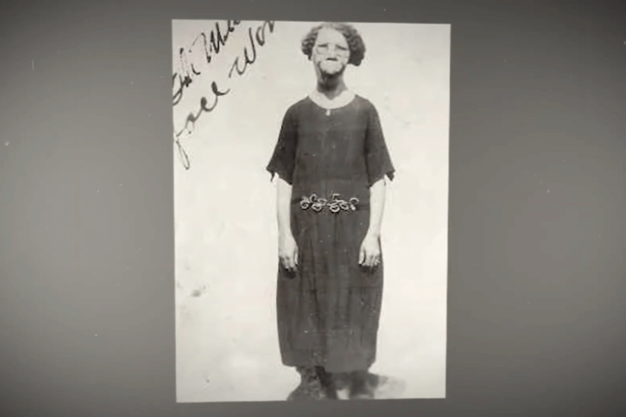 Black and white portrait of a woman standing against a plain backdrop, wearing a dark dress with a decorative belt and a calm, composed expression. She has visible facial and cranial deformities, possibly due to a medical condition, and handwritten text partially visible in the upper left reads, “feel wo…,” adding a personal, historical element to the image.
