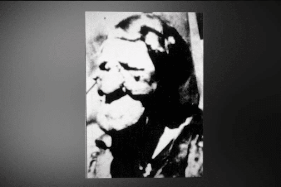 Grainy black and white photo of an individual with extreme facial disfigurement, possibly due to a congenital condition such as neurofibromatosis or a tumor disorder. The image quality is poor, but the person’s facial features appear heavily distorted, representing both the medical challenges and historical stigma faced by those with visible differences.