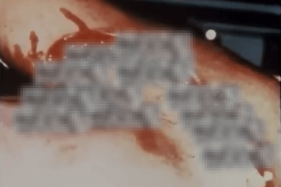 Close-up of a bloodied arm with visible wounds, overlaid with pixelated text to obscure graphic content. The image appears clinical or documentary in nature, possibly related to emergency response or medical training.
