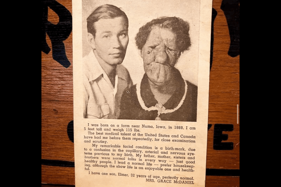 A vintage clipping featuring a portrait of Grace McDaniels, a woman with a severe facial deformity from Sturge-Weber syndrome, posed beside her son Elmer. Beneath the photo is a first-person statement where Grace shares details of her life—her birth in 1888 on a farm in Iowa, her height and weight, medical evaluations, and her explanation of her condition as a birthmark caused by a vascular and nervous system confusion. She notes her family's normalcy, her preference for housekeeping, and expresses that her life is enjoyable and healthy. She concludes by proudly stating she has a “perfectly normal” son.