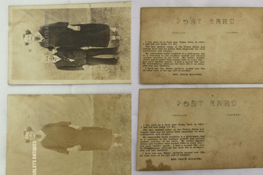 Composite image showing the front and back of two vintage postcards featuring Grace McDaniels, a woman with severe facial disfigurement caused by Sturge-Weber syndrome. The top postcard depicts her standing next to her young son Elmer, both dressed formally; the bottom shows Grace alone in the same setting. The backs of both postcards include a personal printed message from Grace, explaining her condition as a birthmark caused by a capillary and nervous system disorder, affirming her normal family life and expressing pride in her son. The postcards are watermarked “Curley’s Antiques.”