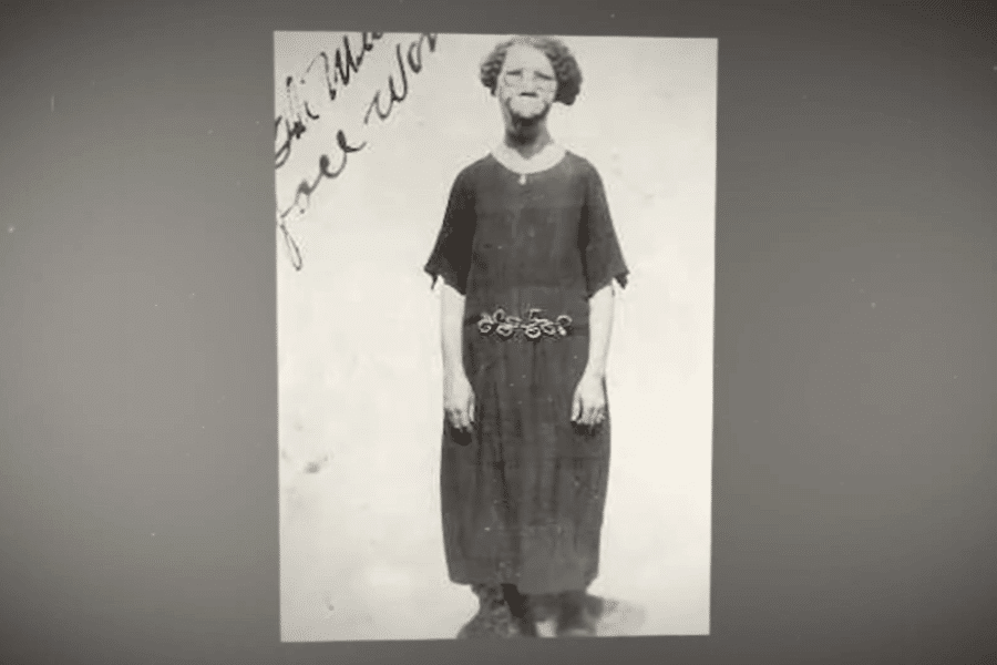 Black and white portrait of a woman standing against a plain backdrop, wearing a dark dress with a decorative belt and a calm, composed expression. She has visible facial and cranial deformities, possibly due to a medical condition, and handwritten text partially visible in the upper left reads, “feel wo…,” adding a personal, historical element to the image.