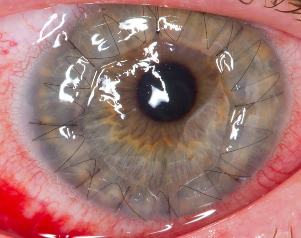 Eye cornea