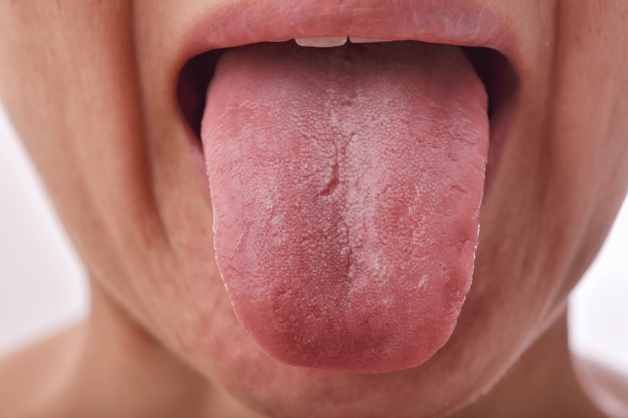 A close-up of a person sticking out their tongue, which appears dry and slightly rough in texture. The image captures the details of the tongue’s surface, including visible taste buds and minor cracks.