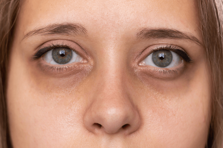 A close-up of a woman's face, focusing on her tired eyes with dark circles and slightly puffy under-eye areas. Her skin appears natural with minimal makeup, and her gaze is directed straight ahead.