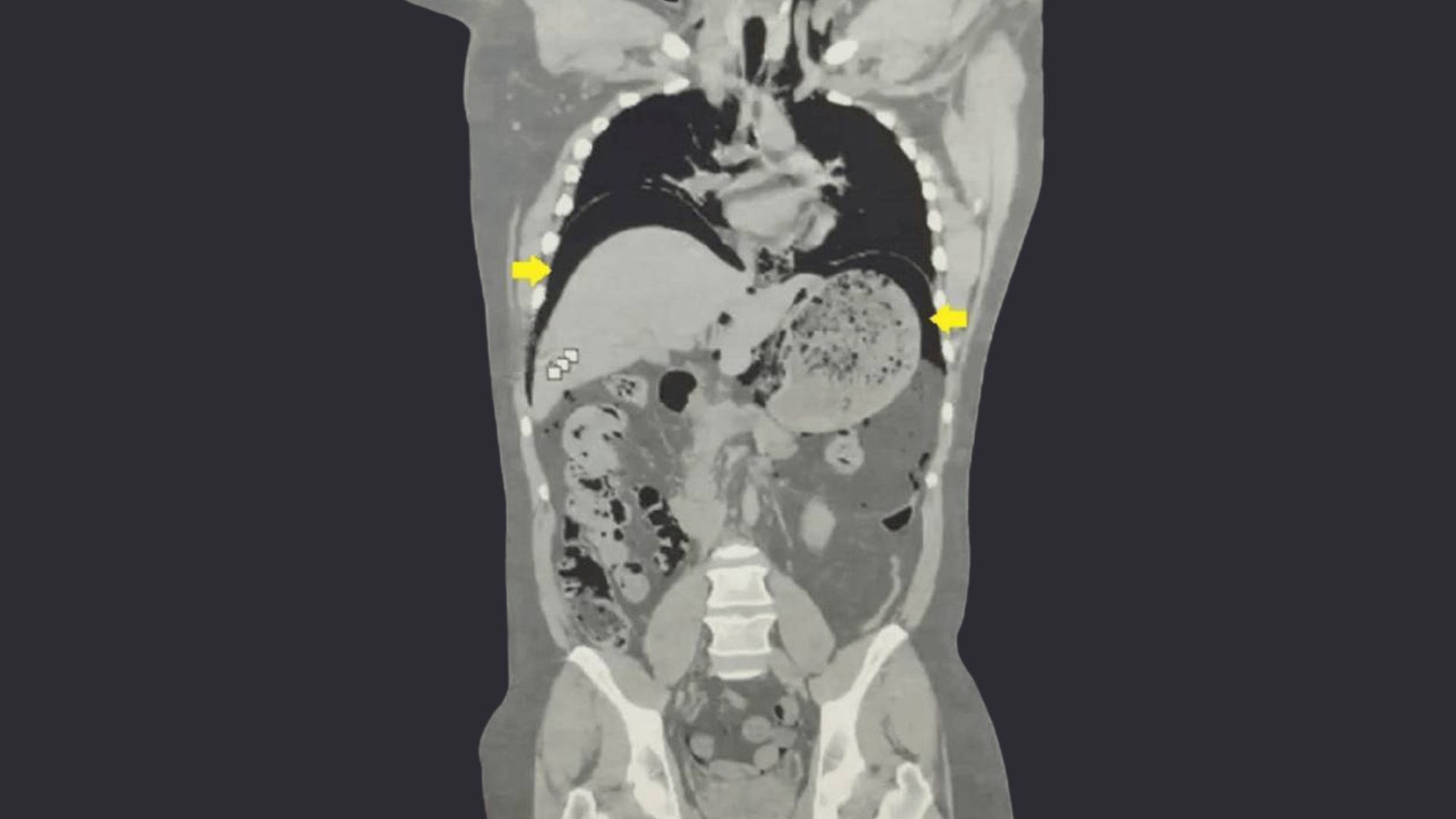 Black-and-white CT scan of the patient.