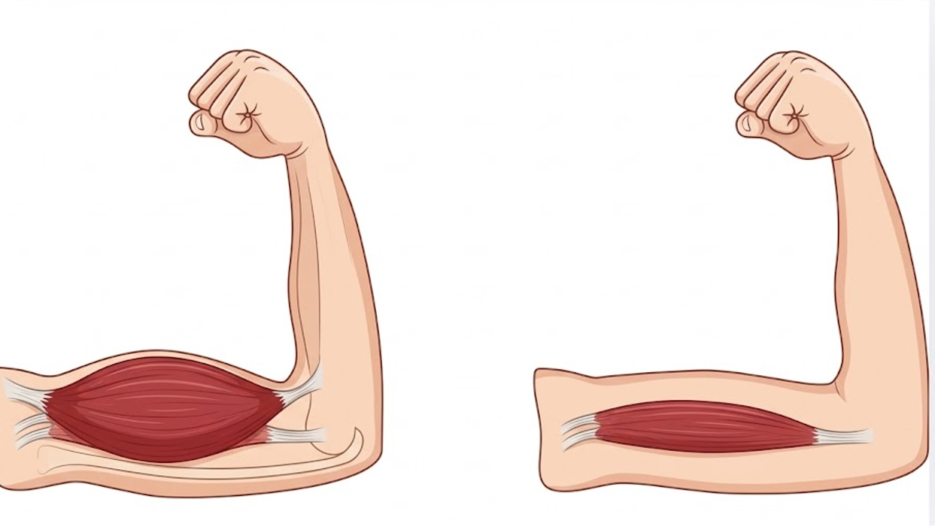 A medical illustration showing a side-by-side comparison of a bicep muscle.
