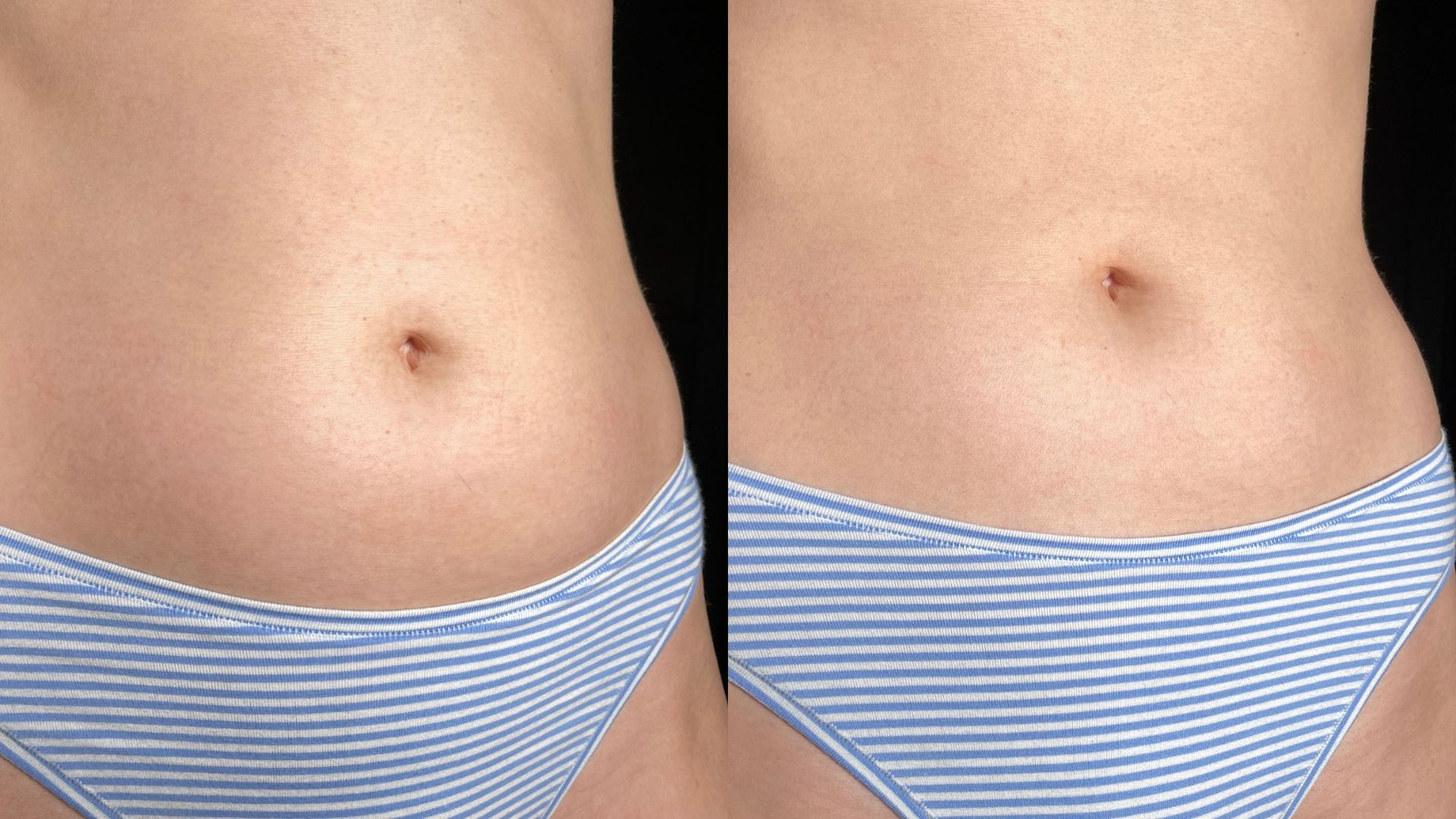 Side by side comparison showing bloated stomach and flatter stomach illustrating digestive discomfort