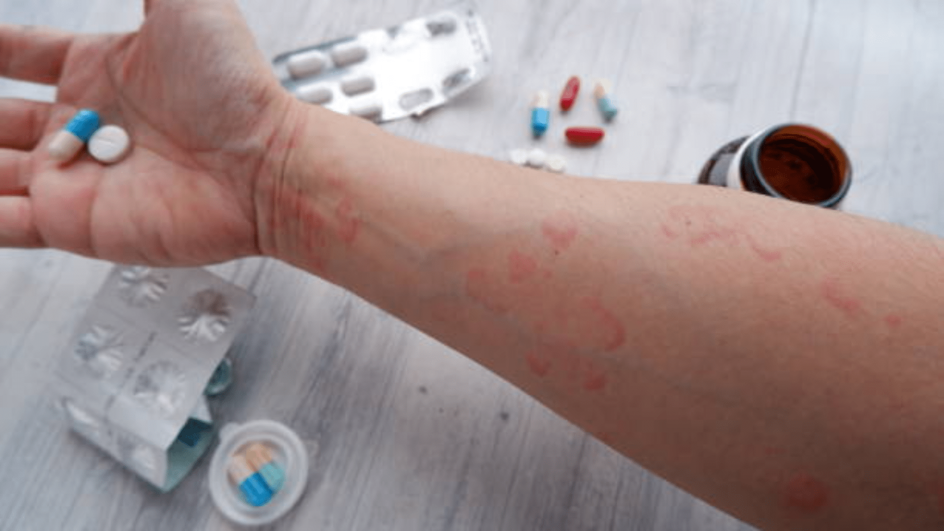 Person with a rash on their arm holding pills near medication packaging.